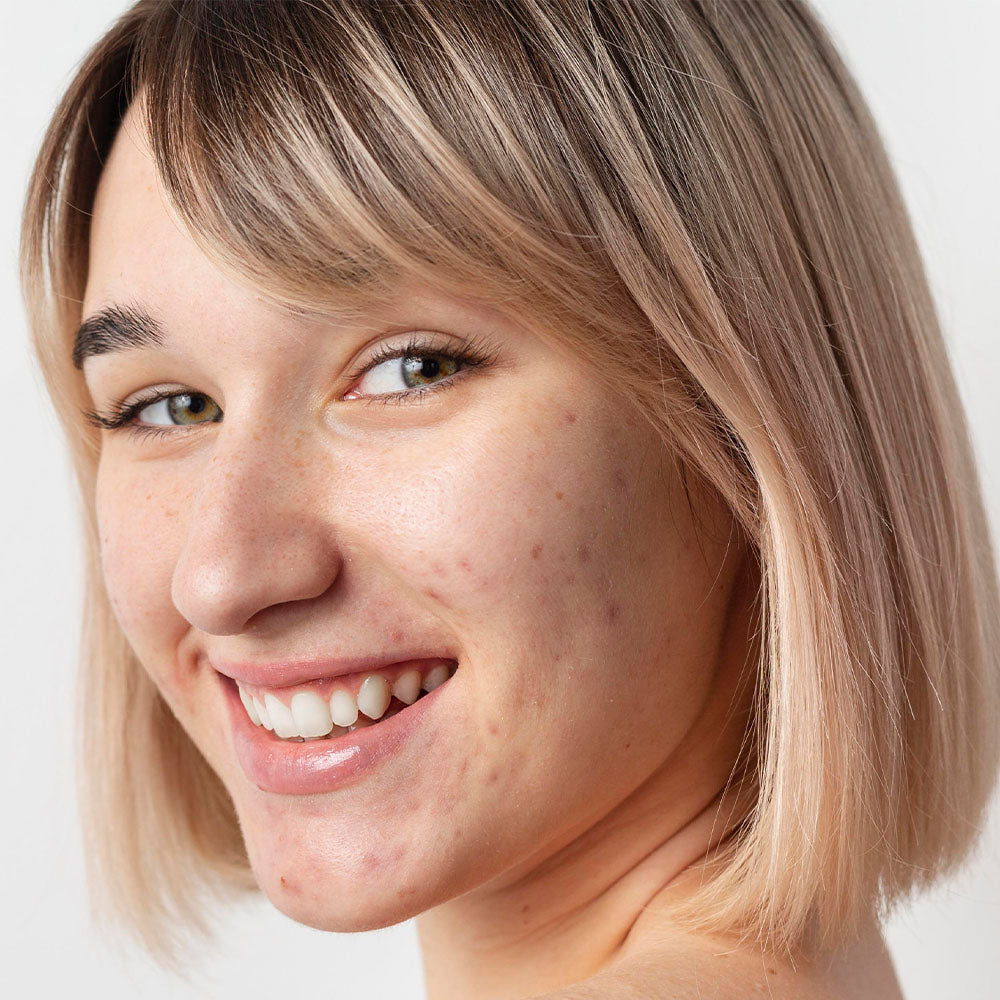 Lekeli Ciltler